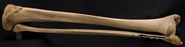 Tibia and fibula from 18 year-old male
