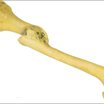 Plastic cast of a male modern human right femur. The cast displays the pathology of an unset healed fracture. Catalog number EO401737. 