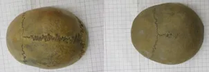 Craniums of a 20 year-old (left) and a 70 year-old (right). Images courtesy of: Smithsonian Institution