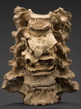 Spinal column shows some misshapen bones.