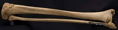 Tibia and fibula from 18 year-old male